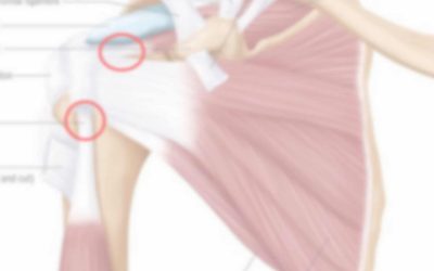 All About Tendonitis